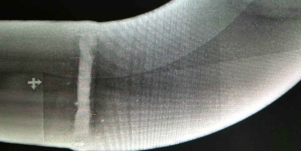 Radiographic Testing (RT)